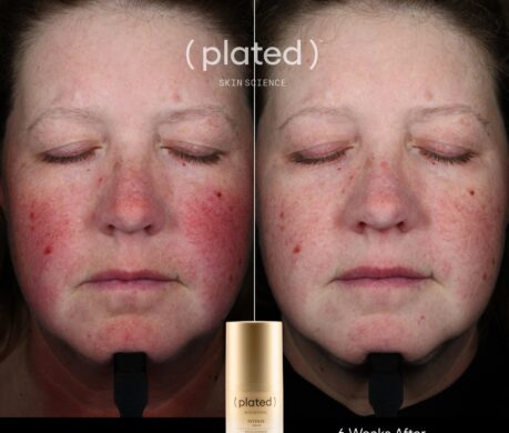 INTENSE_Before After 459x390